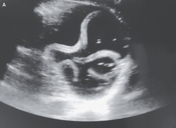 'Ultrassom de pesadelo' revela vermes parasitas dentro do estômago de homem (FOTO) - Sputnik Brasil