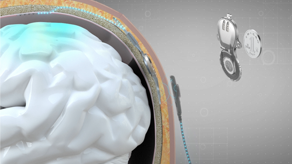 Implante cerebral BCI sem fio desenvolvido por cientistas chineses - Sputnik Brasil