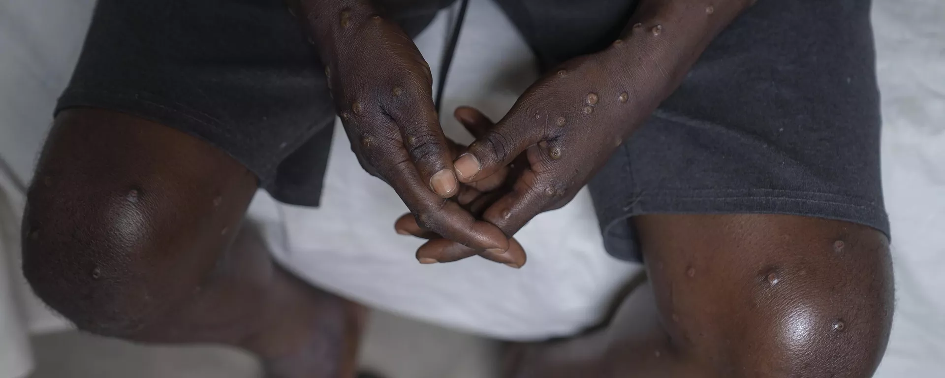 Homem não identificado infectado com mpox no Hospital Geral de Goma. República Democrática do Congo, 16 de julho de 2024 - Sputnik Brasil, 1920, 11.10.2024