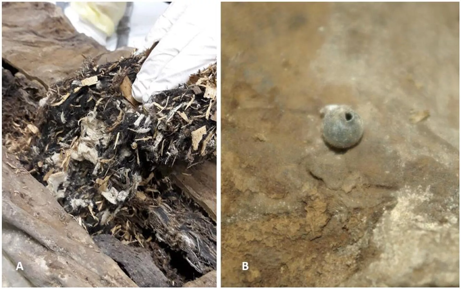 (A) A remoção de partes do material estranho da parede abdominal dorsal revelou uma mistura de tecido branco fragmentado, pequenas lascas de madeira e material vegetal, juntamente com alguns resíduos de tecido amorfo amarronzado. (B) A esfera estranha redonda detectada na pelve esquerda tinha um pequeno orifício com uma borda elevada - Sputnik Brasil, 1920, 04.05.2025