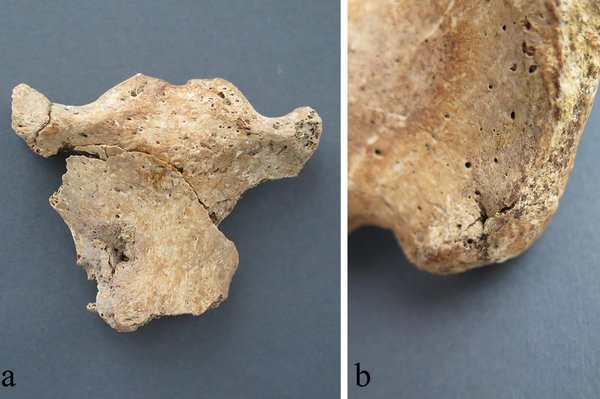 Ferida perfurante na face anterior do manúbrio; ferida perfurante na face posterior do ílio direito - Sputnik Brasil