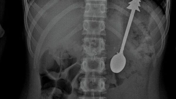 Criança engole acidentalmente uma colher de 14cm - Sputnik Brasil