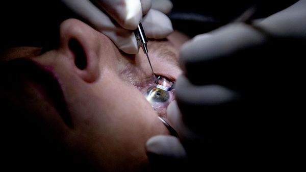 Paciente passa por cirurgia no olho, em 1º de fevereiro de 2017 - Sputnik Brasil