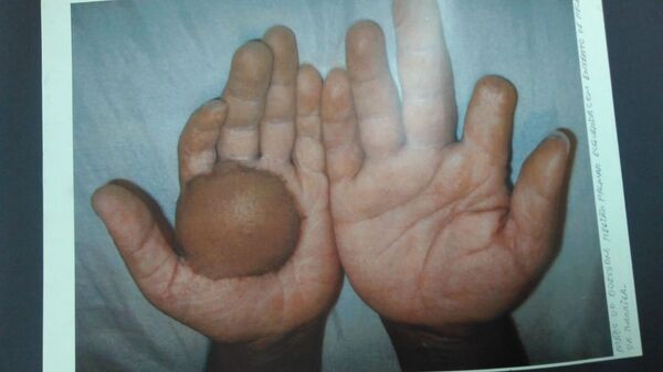 Queimadura na mão de um dos contaminados - Sputnik Brasil