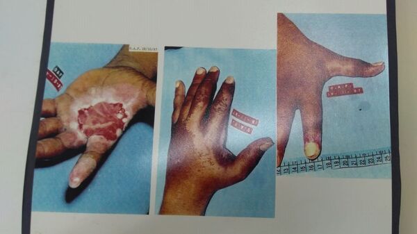 Queimadura na mão de um dos contaminados - Sputnik Brasil