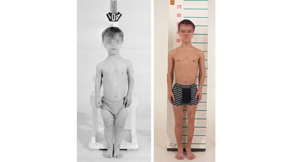 Paciente de 8 anos com acondroplasia e altura de 104 cm (à esquerda) passou por um alongamento de braços (de 10 cm) e das pernas (de 37 cm), tendo crescido até 151 cm (à direita) - Sputnik Brasil