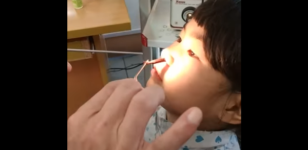 Sanguessuga é removida de nariz de garota no Vietnã - Sputnik Brasil