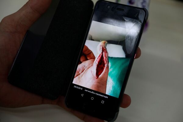 Bombeiro mostra foto de seu dedo depois de ser picado por cobra-real em Bangkok - Sputnik Brasil