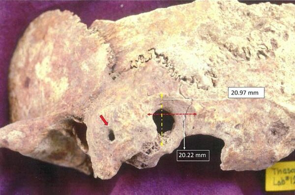 Cientistas descobrem na Grécia crânio de 1.600 anos com evidências de antiga cirurgia (FOTO) Cientistas descobrem na Grécia crânio de 1.600 anos com evidências de antiga cirurgia (FOTO) - Sputnik Brasil