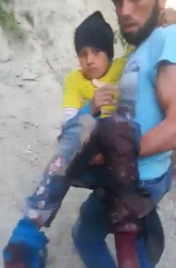 Um menino sírio ferido em ambas as pernas na fronteira da Turquia - Sputnik Brasil