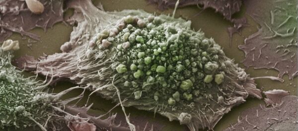 Cientistas estão saudando um avanço no tratamento do câncer que vai inaugurar uma nova era para aqueles que lutam contra a doença usando o próprio sistema imunológico do corpo para atacar células cancerosas. - Sputnik Brasil