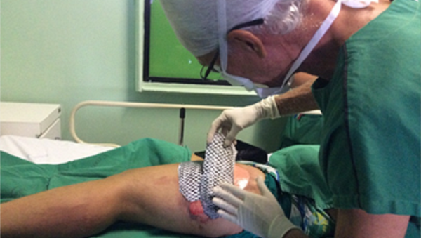 Pele de tilápia aplicada em paciente queimado - Sputnik Brasil