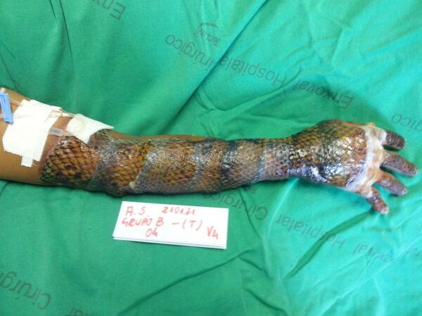 Pele de tilápia aplicada em paciente queimado - Sputnik Brasil